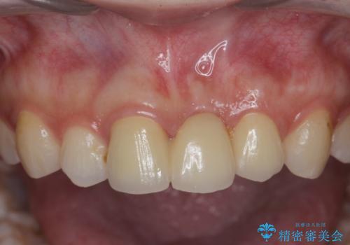 前歯のブリッジ治療の治療後