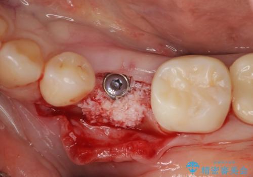 乳歯がぐらついてきた インプラントを用いた機能回復の治療中