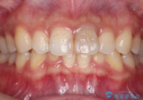 前歯のブリッジ治療の治療前