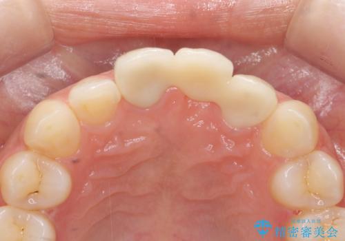 前歯のブリッジ治療の治療後