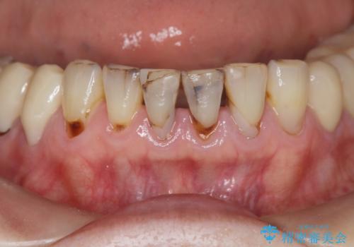 シェーグレン症候群で多発した虫歯　前歯のセラミック治療の治療前