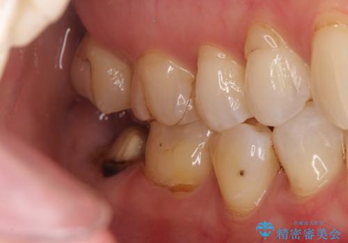 【オールセラミッククラウン】他院で治療した被せものが外れたの治療前
