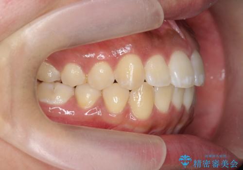 [ マウスピース矯正 ]  前歯の出っ歯感を改善したいの治療後