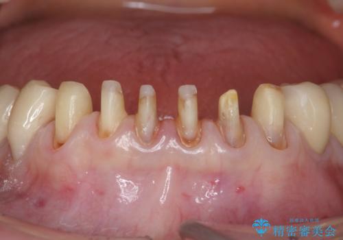 シェーグレン症候群で多発した虫歯 前歯のセラミック治療の治療中