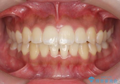 [ マウスピース矯正 ]  前歯の出っ歯感を改善したいの症例 治療後