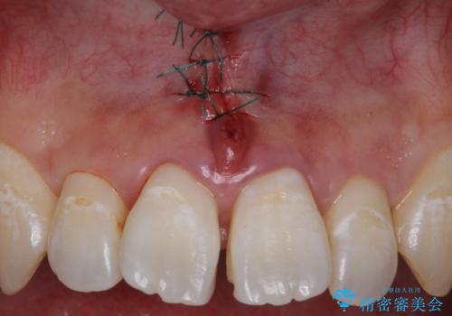 上唇小帯の切除の治療中