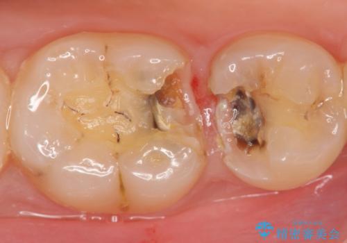 歯が黒くなってきた　虫歯のセラミック治療の治療中