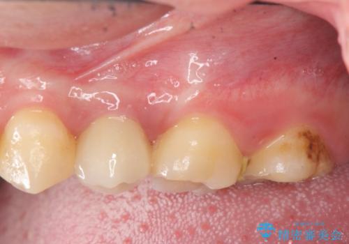 [ 深い虫歯 ]　歯周外科を行い抜歯を回避の症例 治療後