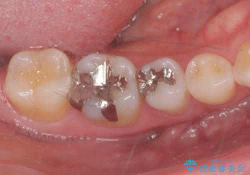 銀の詰め物を白くしたい。の治療前