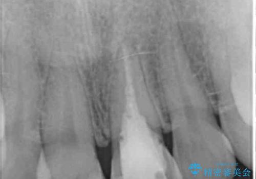 前歯のブリッジ治療の治療前