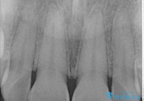 転んで欠けてしまった前歯 オーダーメイドのオールセラミッククラウンの治療前