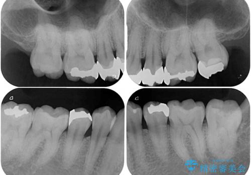オープンバイトと目立つ銀歯 インビザライン矯正とセラミック修復治療の治療前