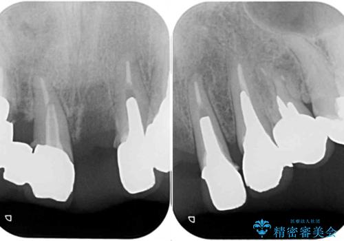 転倒で折れてしまった前歯 インプラントによるオールセラミックブリッジ治療の治療前