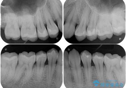 オープンバイトと目立つ銀歯 インビザライン矯正とセラミック修復治療の治療後