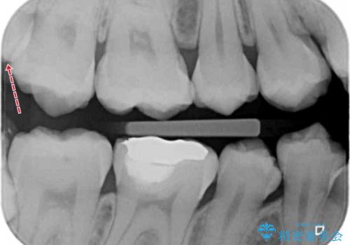 親知らずの手前の歯　抜歯後に適合の良いインレーでの修復処置の治療前