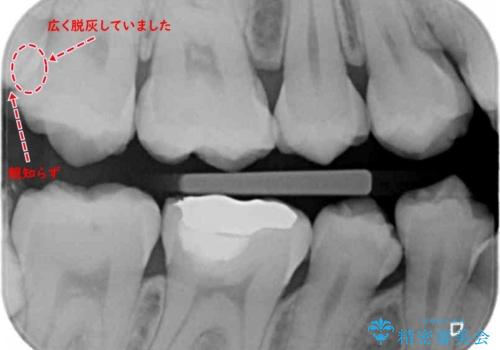 親知らずの手前の歯　抜歯後に適合の良いインレーでの修復処置