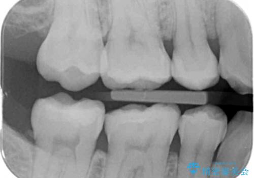 歯と歯の間の虫歯 セラミックインレーでの治療の治療前