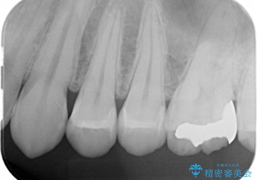 コンタクトカリエスの治療の治療後