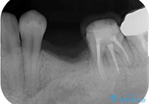 乳歯がぐらついてきた　インプラントを用いた機能回復の治療前
