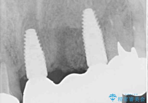 転倒で折れてしまった前歯 インプラントによるオールセラミックブリッジ治療の治療後