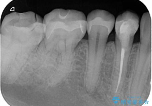下の歯の銀歯が目立つの治療後