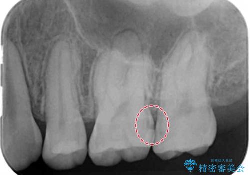 歯と歯の間に隠れた虫歯　セラミックインレーによる治療の治療前