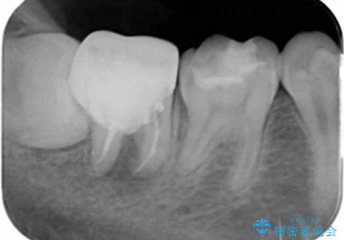 [ 精密根管治療 ]  他院で抜歯しかないと言われた歯を残すの治療前