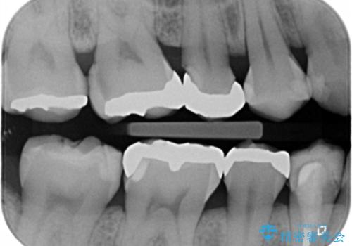 下の歯の銀歯が目立つの治療前