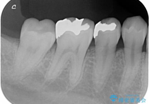 銀の詰め物を白くしたい。の治療前