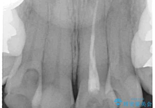 内側に倒れた前歯と口元の突出感 ワイヤー装置での抜歯矯正の治療前