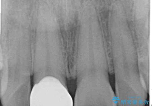 転んで欠けてしまった前歯 オーダーメイドのオールセラミッククラウンの治療後