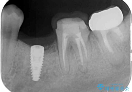 乳歯がぐらついてきた　インプラントを用いた機能回復の治療中