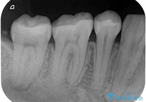 歯と歯の間の虫歯 セラミックインレーでの治療の治療後