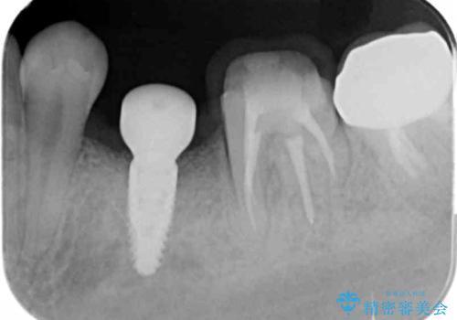 乳歯がぐらついてきた インプラントを用いた機能回復の治療中