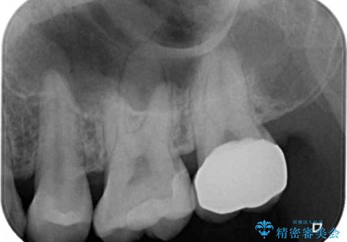 樹脂の詰め物をセラミックで修復の治療後