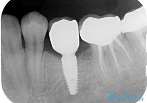 乳歯がぐらついてきた インプラントを用いた機能回復の治療後