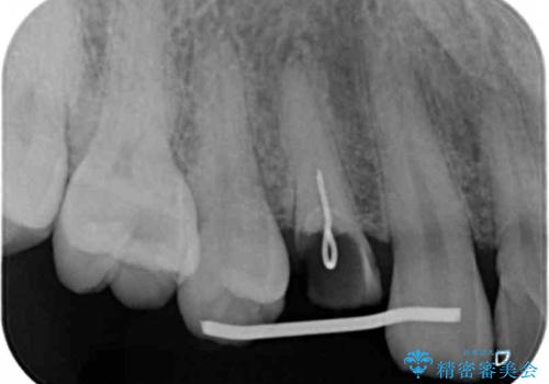 保険治療では抜歯適応になる歯 抜歯せずに保存(エクストリュージョン)の治療中