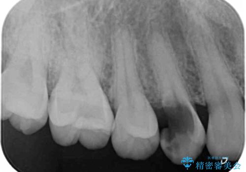 保険治療では抜歯適応になる歯　抜歯せずに保存(エクストリュージョン)の症例 治療前
