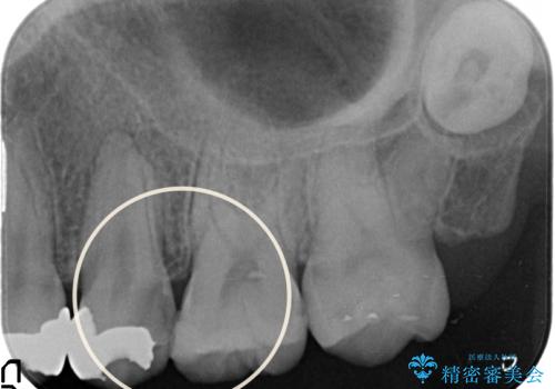 [ 深い虫歯 ]　歯周外科を行い抜歯を回避