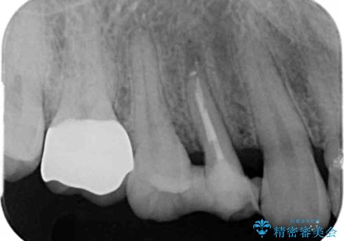 保険治療では抜歯適応になる歯　抜歯せずに保存(エクストリュージョン)の治療中