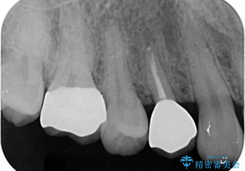 保険治療では抜歯適応になる歯　抜歯せずに保存(エクストリュージョン)の症例 治療後