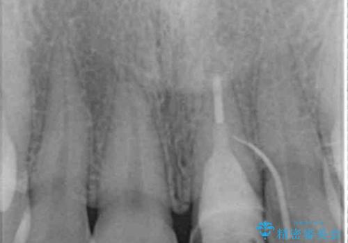 前歯のブリッジ治療の治療中