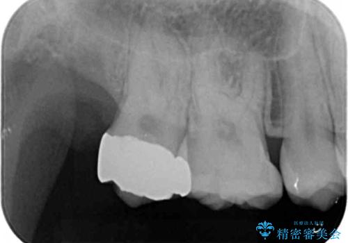 親知らずの手前の歯　抜歯後に適合の良いインレーでの修復処置の治療後