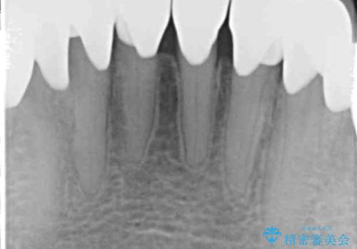 シェーグレン症候群で多発した虫歯 前歯のセラミック治療の治療後