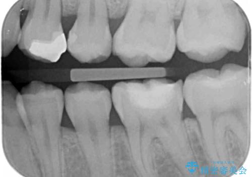 変色した樹脂の詰め物 セラミックでのやり替えの治療前