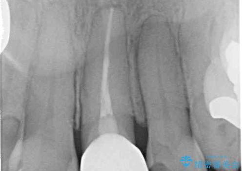内側に倒れた前歯と口元の突出感 ワイヤー装置での抜歯矯正の治療後