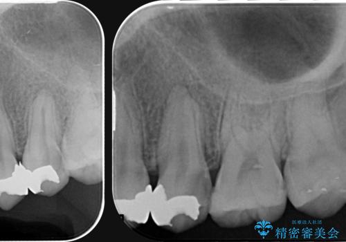 [ 深い虫歯 ]　歯周外科を行い抜歯を回避の治療前