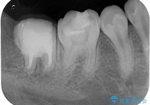 [ 精密根管治療 ]  他院で抜歯しかないと言われた歯を残すの治療中