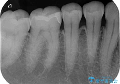 奥歯の虫歯 セラミックインレーでの治療の治療前