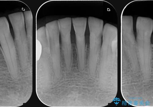 シェーグレン症候群で多発した虫歯 前歯のセラミック治療の治療前